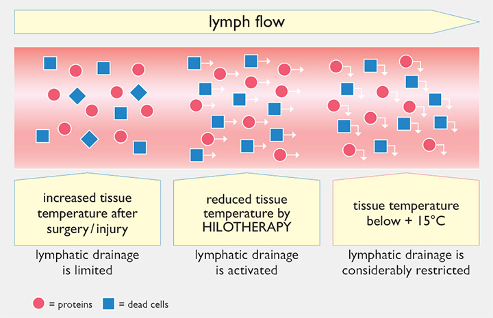 Effects of Hilotherapy on lymphatic drainage